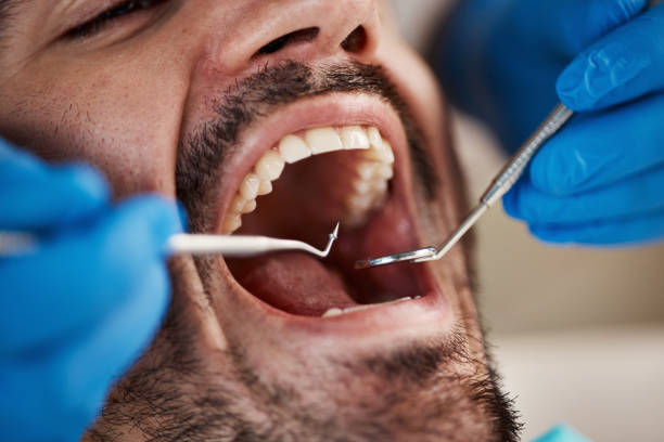 Best Emergency Dentist for Lost Fillings or Crowns in North Canton, OH