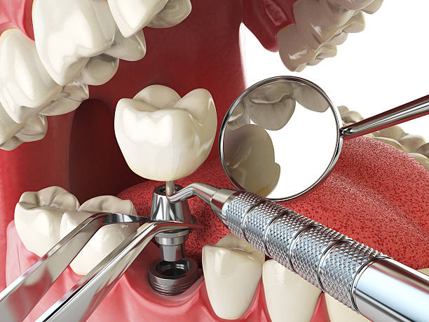 Best Emergency Dental Extractions in North Canton, OH